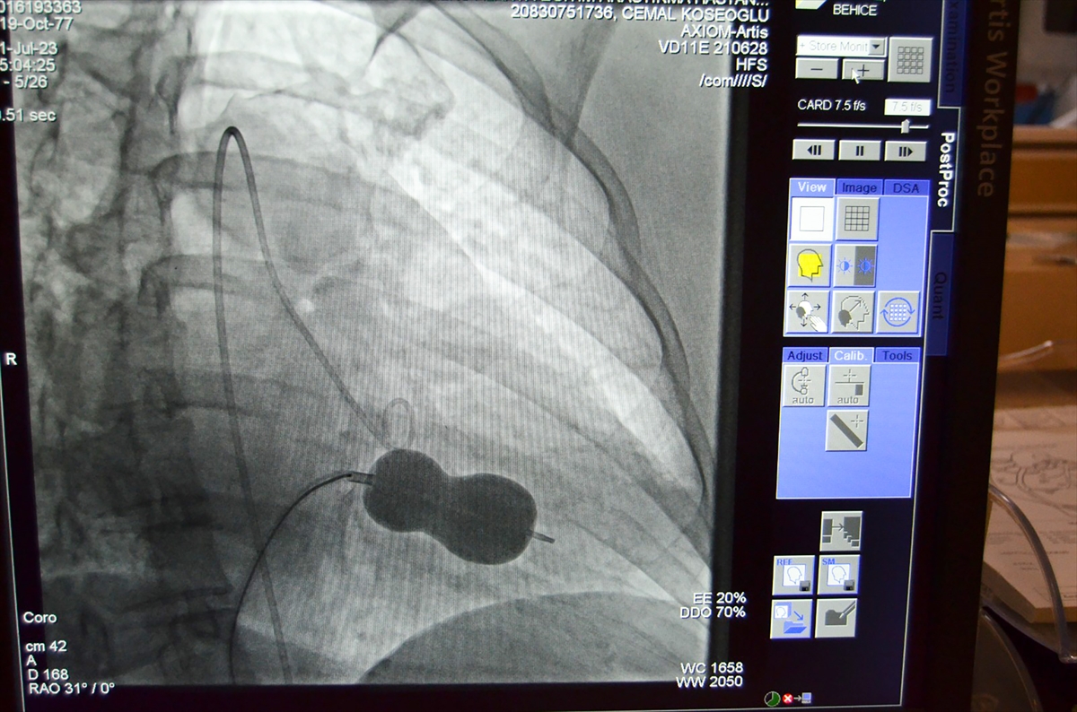 Alanya'da kalp kapağı hastası ameliyatsız yöntemle sağlığına kavuştu