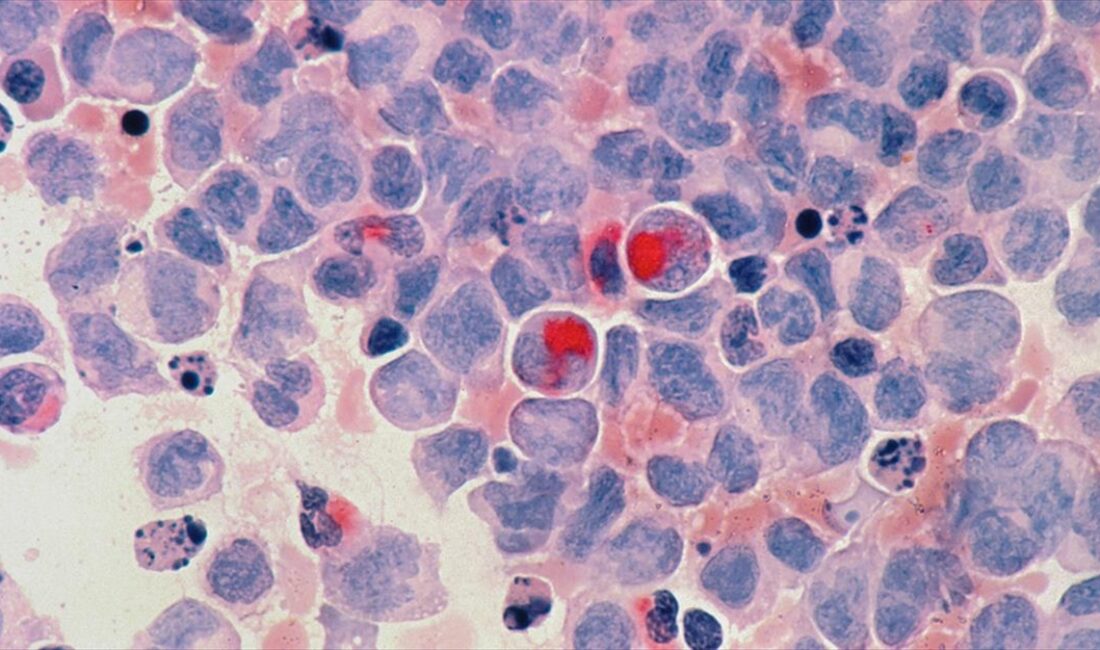 Türk Hematoloji Derneği Genel Sekreteri Prof. Dr. Reyhan Küçükkaya, yüksek