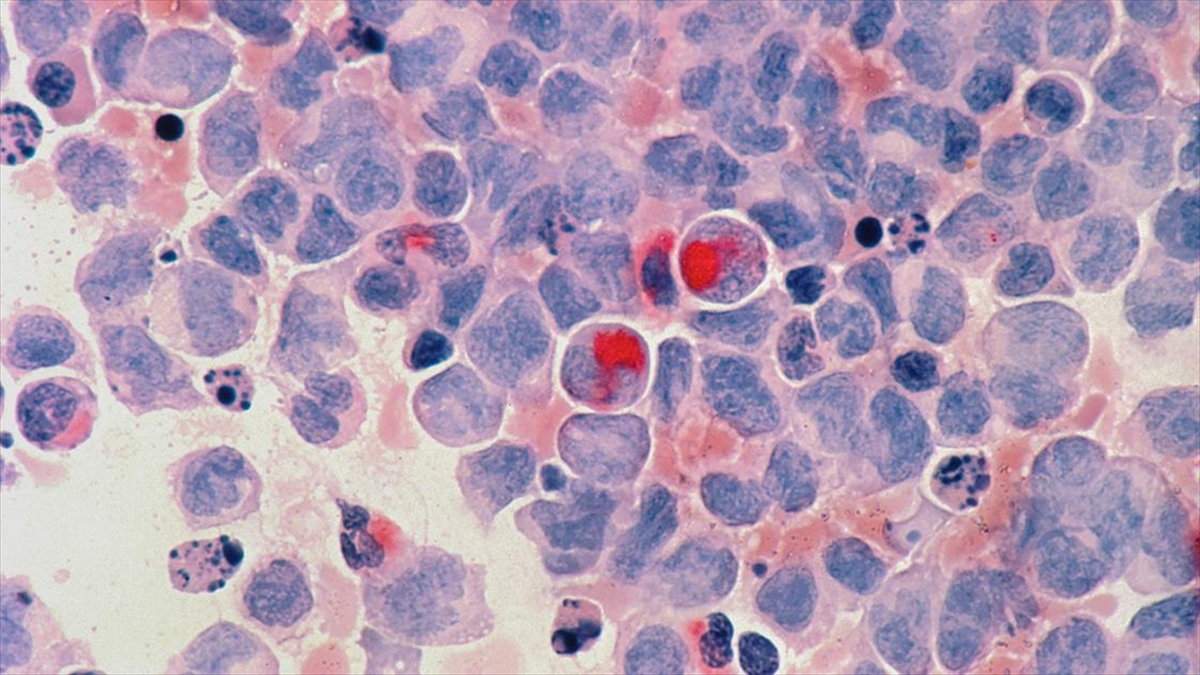 Türk Hematoloji Derneği Genel Sekreteri Prof. Dr. Reyhan Küçükkaya, yüksek