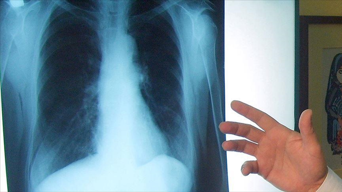 Ege Üniversitesinde (EÜ) akciğer kanseri tipleri içerisinde en fazla görülen