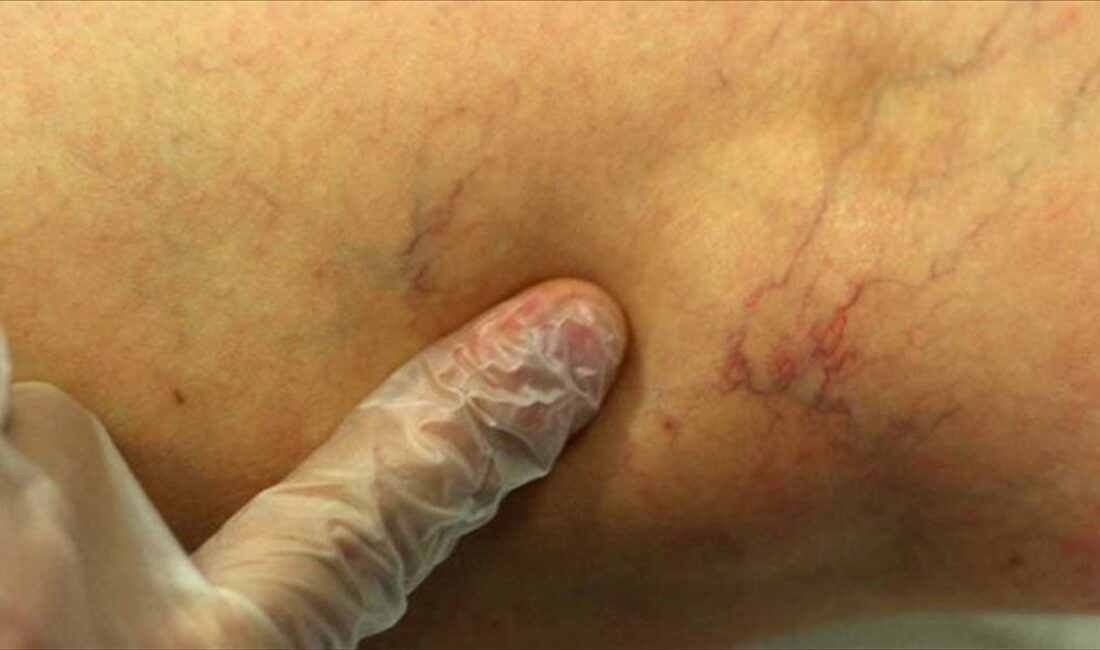 Ulusal Vasküler ve Endovasküler Cerrahi Derneği Başkanı Doç. Dr. Soner