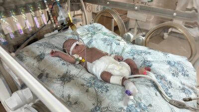 Balıkesir'de prematüre olarak dünyaya gelen ve kalbinden çıkan iki büyük