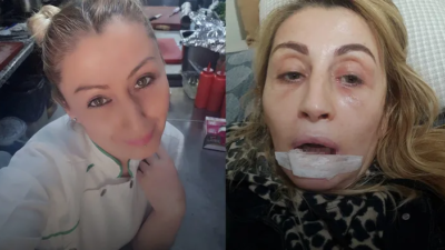 Antalya'da estetik işlem sonrası dudağında doku kaybı yaşadığını ileri süren