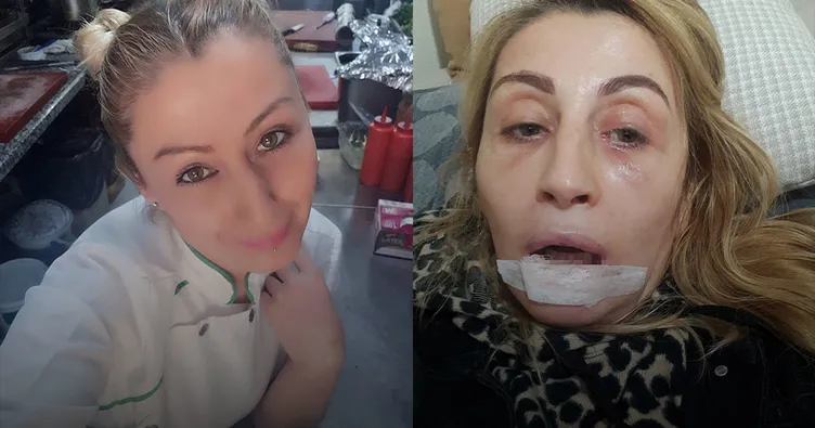 Antalya'da estetik işlem sonrası dudağında doku kaybı yaşadığını ileri süren